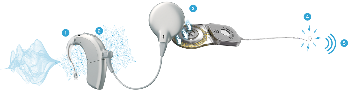 A numbered diagram showing how the Naída CI Marvel cochlear implant sound processor works