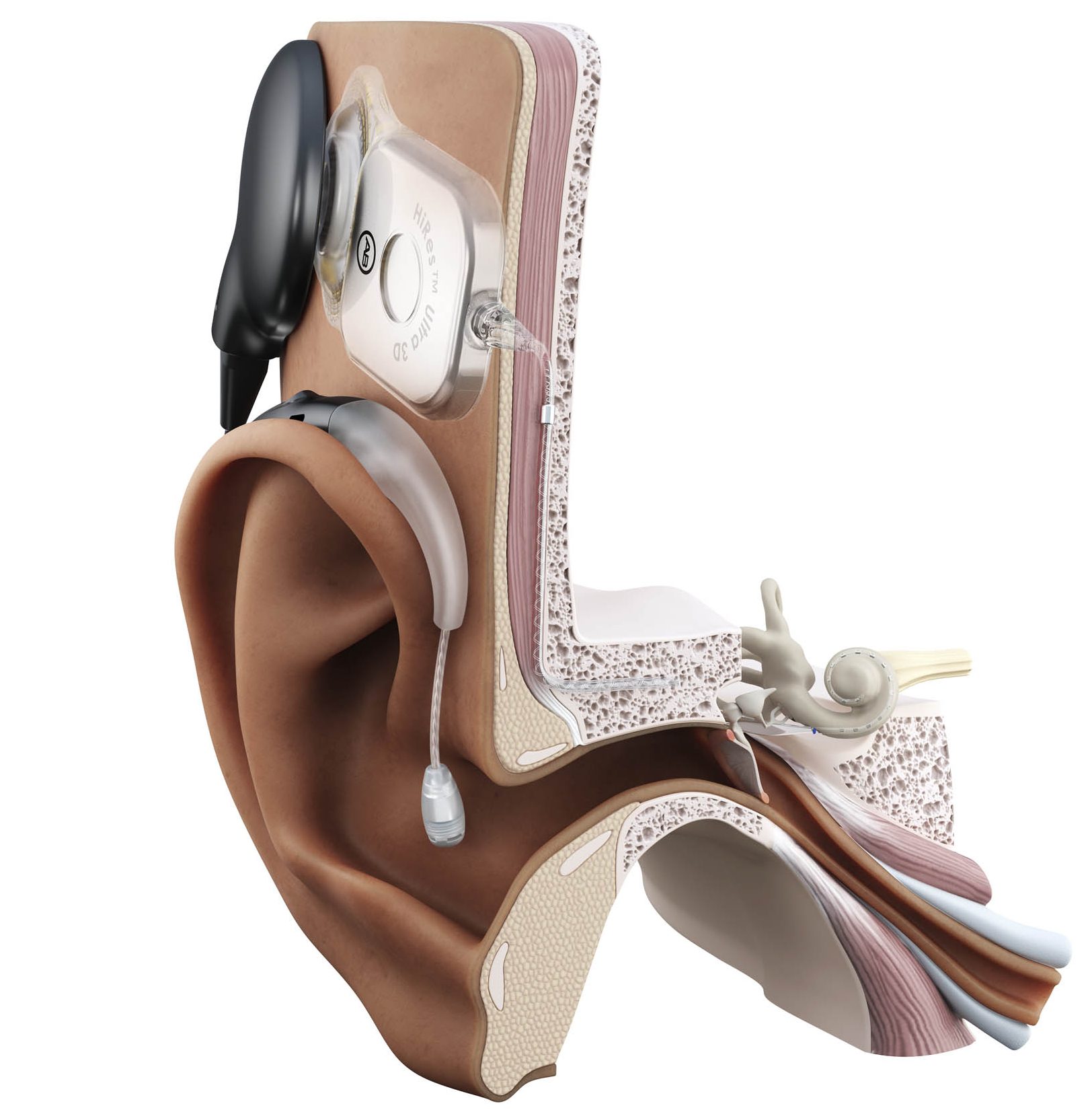 Illustration of AB HiRes Ultra 3D implant and sound processor 