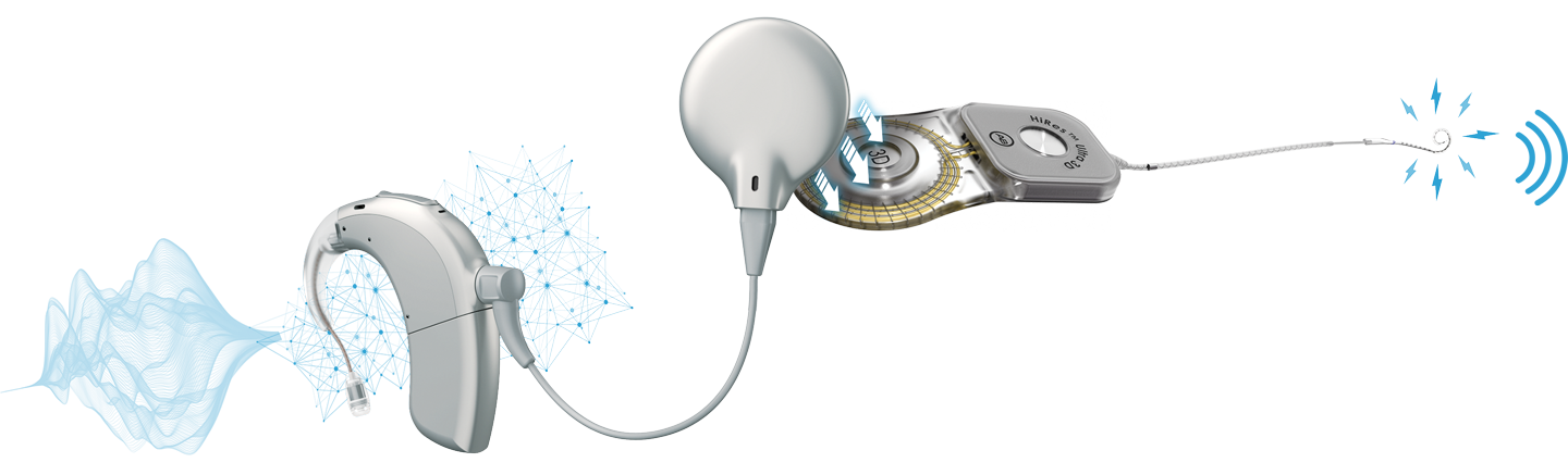 A diagram showing how the Naída CI Marvel cochlear implant sound processor works