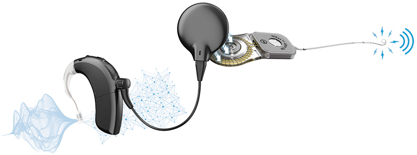 Diagram showing how the parts of a cochlear implant work